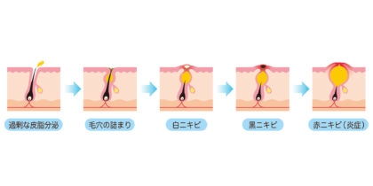 ニキビができる原因は？