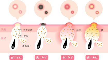 ニキビの種類